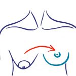 breast asymmetery icon 2