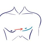 male chest surgery icon 2